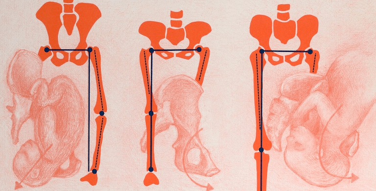 Mal au dos : ma douleur provient-elle de mon articulation Sacro-Iliaque&nbsp;?